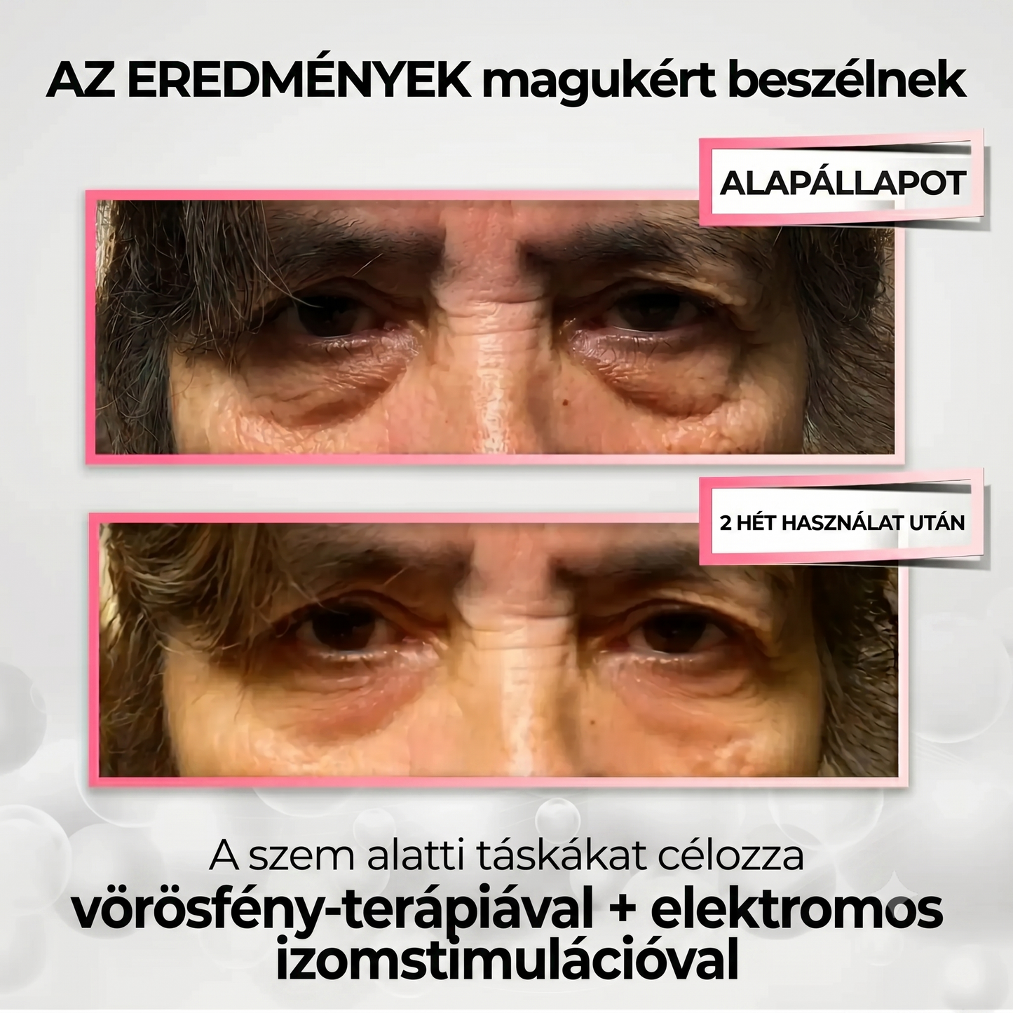 Lumiera EyeLift 2 az 1-ben vörösfény-terápia + EMS a szem alatti táskák eltüntetésére