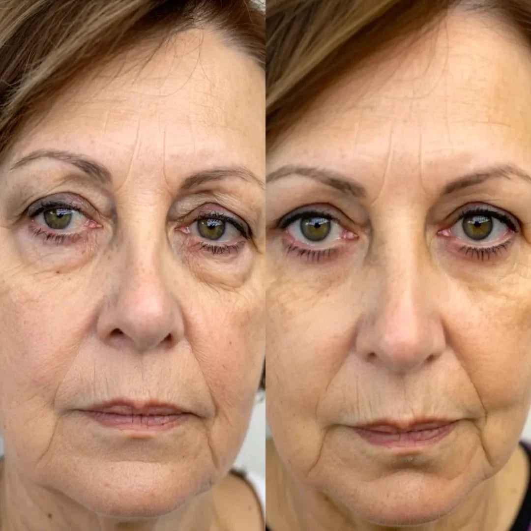 Lumiera EyeLift 2 az 1-ben vörösfény-terápia + EMS a szem alatti táskák eltüntetésére